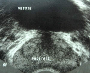 volume prostate échographie